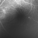 Central Serous Chorioretinopathy Smokestack 2 Central Serous Chorioretinopathy Smokestack 2