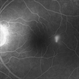 Central Serous Chorioretinopathy Smokestack 3 Central Serous Chorioretinopathy Smokestack 3