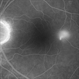 Central Serous Chorioretinopathy Smokestack 4 Central Serous Chorioretinopathy Smokestack 4