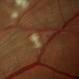 Arterio-Venous Nipping, Venous Beading