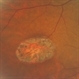 Congenital Hypertrophy of the Retinal Pigment Epithelium (CHRPE) Congenital Hypertrophy of the Retinal Pigment Epithelium (CHRPE)