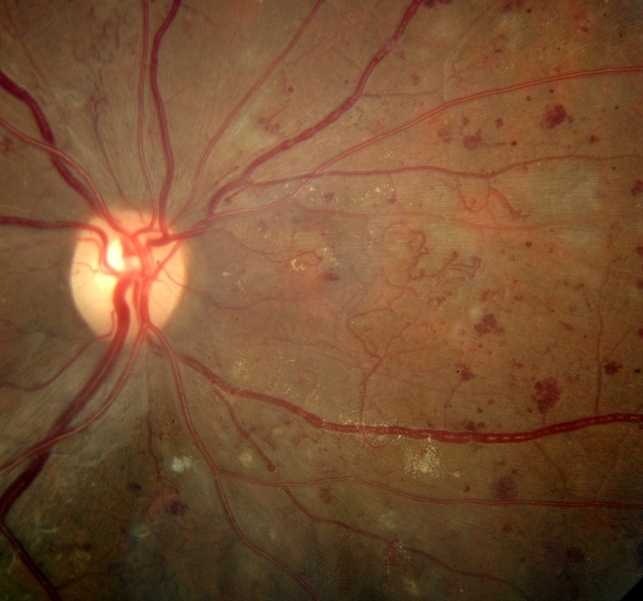 Intraretinal Microvascular Abnormalities And Venous Beading Retina Image Bank