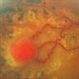 Retinal Hemangioma Retinal Hemangioma