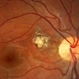 Toxoplasma Chorioretinal Scar Toxoplasma Chorioretinal Scar