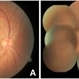 Candida Endophthalmitis Candida Endophthalmitis
