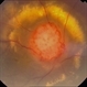 Color Photo of Optic Disc Capillary Hemangioblastoma Color Photo of Optic Disc Capillary Hemangioblastoma