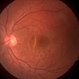 Choroidal Hemangioma Choroidal Hemangioma