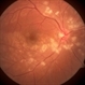 Hypertensive Retinopathy Hypertensive Retinopathy