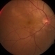 Vogt-Koyanagi-Harada Syndrome Vogt-Koyanagi-Harada Syndrome