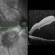 Vogt-Koyanagi-Harada Syndrome Vogt-Koyanagi-Harada Syndrome