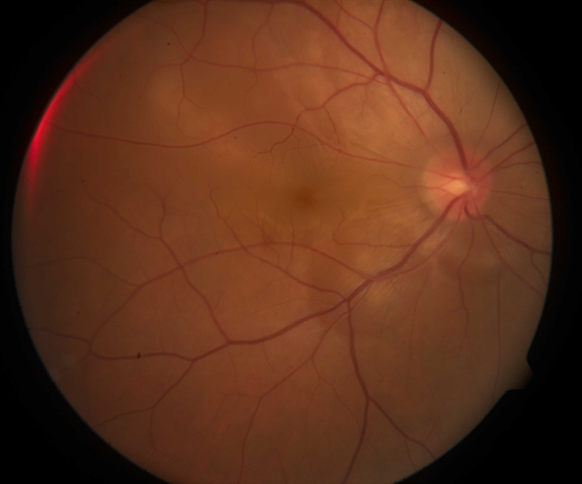 VogtKoyanagiHarada Syndrome Retina Image Bank