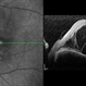 Vogt-Koyanagi-Harada Syndrome Vogt-Koyanagi-Harada Syndrome