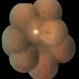 Multiple Evanescent White Dot Syndrome (MEWDS) Multiple Evanescent White Dot Syndrome (MEWDS)