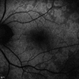 Multiple Evanescent White Dot Syndrome (MEWDS) Multiple Evanescent White Dot Syndrome (MEWDS)