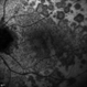 Multiple Evanescent White Dot Syndrome (MEWDS) Multiple Evanescent White Dot Syndrome (MEWDS)