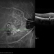 Polypoidal Choroidal Vasculopathy: Case 1 - Image 5 of 7 Polypoidal Choroidal Vasculopathy: Case 1 - Image 5 of 7