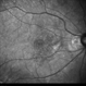 Polypoidal Choroidal Vasculopathy: Case 1 - Image 3 of 7
