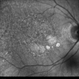 Geographic Atrophy - Case 1: Photo 6 of 6 Geographic Atrophy - Case 1: Photo 6 of 6