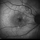 Polypoidal Choroidal Vasculopathy: Case 1 - Image 2 of 7
