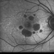 Geographic Atrophy - Case 1: Photo 5 of 6 Geographic Atrophy - Case 1: Photo 5 of 6