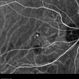 Polypoidal Choroidal Vasculopathy - Case 1