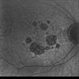 Geographic Atrophy - Case 1: Photo 4 of 6 Geographic Atrophy - Case 1: Photo 4 of 6
