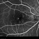 Polypoidal Choroidal Vasculopathy: Case 1 - Image 1 of 7