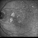 Geographic Atrophy - Case 1: Photo 3 of 6 Geographic Atrophy - Case 1: Photo 3 of 6