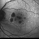 Geographic Atrophy - Case 1: Photo 2 of 6 Geographic Atrophy - Case 1: Photo 2 of 6