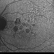 Geographic Atrophy - Case 1: Photo 1 of 6 Geographic Atrophy - Case 1: Photo 1 of 6