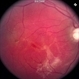 Diffuse Choroidal  Hemangioma Diffuse Choroidal  Hemangioma