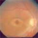Chloroquine Maculopathy Chloroquine Maculopathy