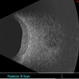 Diffuse Choroid hemangioma Diffuse Choroid hemangioma