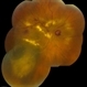 Choroidal Melanoma With Radiation Retinopathy