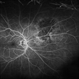 Choroidal Nevus[003]