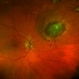 Choroidal Nevus[004]
