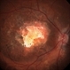 Choroidal Osteoma