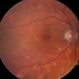Choroiditis Choroiditis