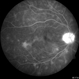 Choroiditis Choroiditis