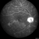 Multifocal Choroiditis Multifocal Choroiditis