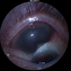 Ciliary mass Ciliary mass