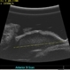 Ciliary mass ultrasound Ciliary mass ultrasound