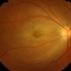 Cilioretinal Artery Occlusion Cilioretinal Artery Occlusion