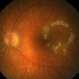 Circinate Ring Circinate Ring
