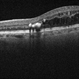 Circinate Ring OCT Circinate Ring OCT