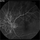 Serpiginous Serpiginous