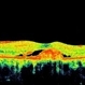 Heredomacular Degeneration Heredomacular Degeneration