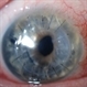 Cornea Transplant Rupture 1