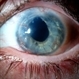 Corneal Abnormal Blood Vessels