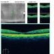 Tamoxifen Maculopathy Tamoxifen Maculopathy